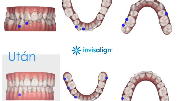 „Ha visszamehetnék az időben, akkor sem döntenék másként a fogszabályozásról!”